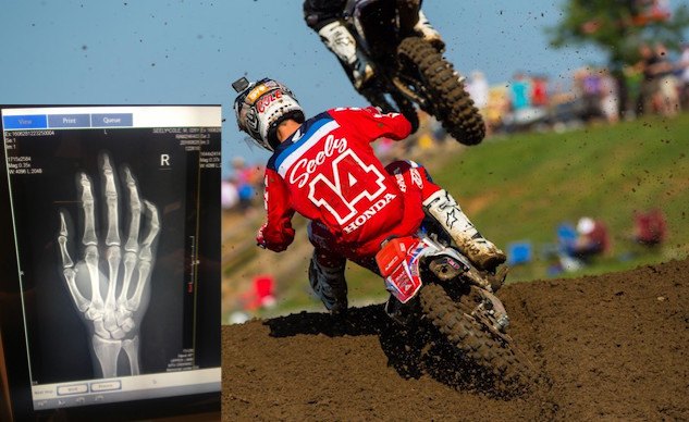 cole seely gets a bionic hand not really
